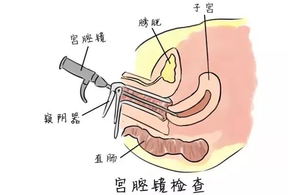 宫腔镜术后半个月来例假，解读与指导